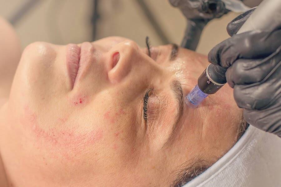Dr. Melinda Silva MD - Microneedling Image Dr. Melinda Silva MD - Microneedling Image