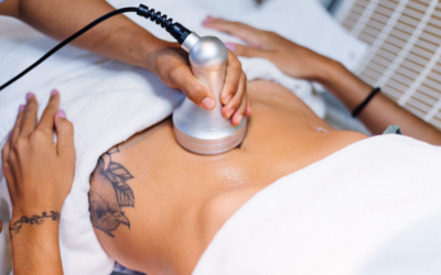 What Factors Influence Emsculpt Effectiveness for Locals